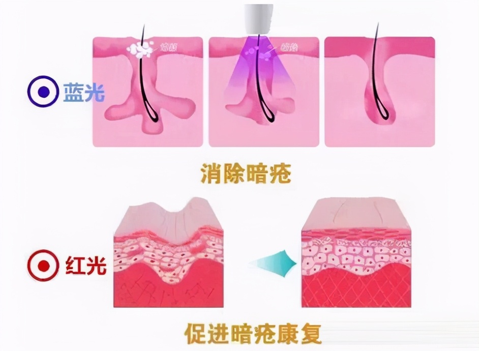 光电类医美项目有什么,医美科普纹眉