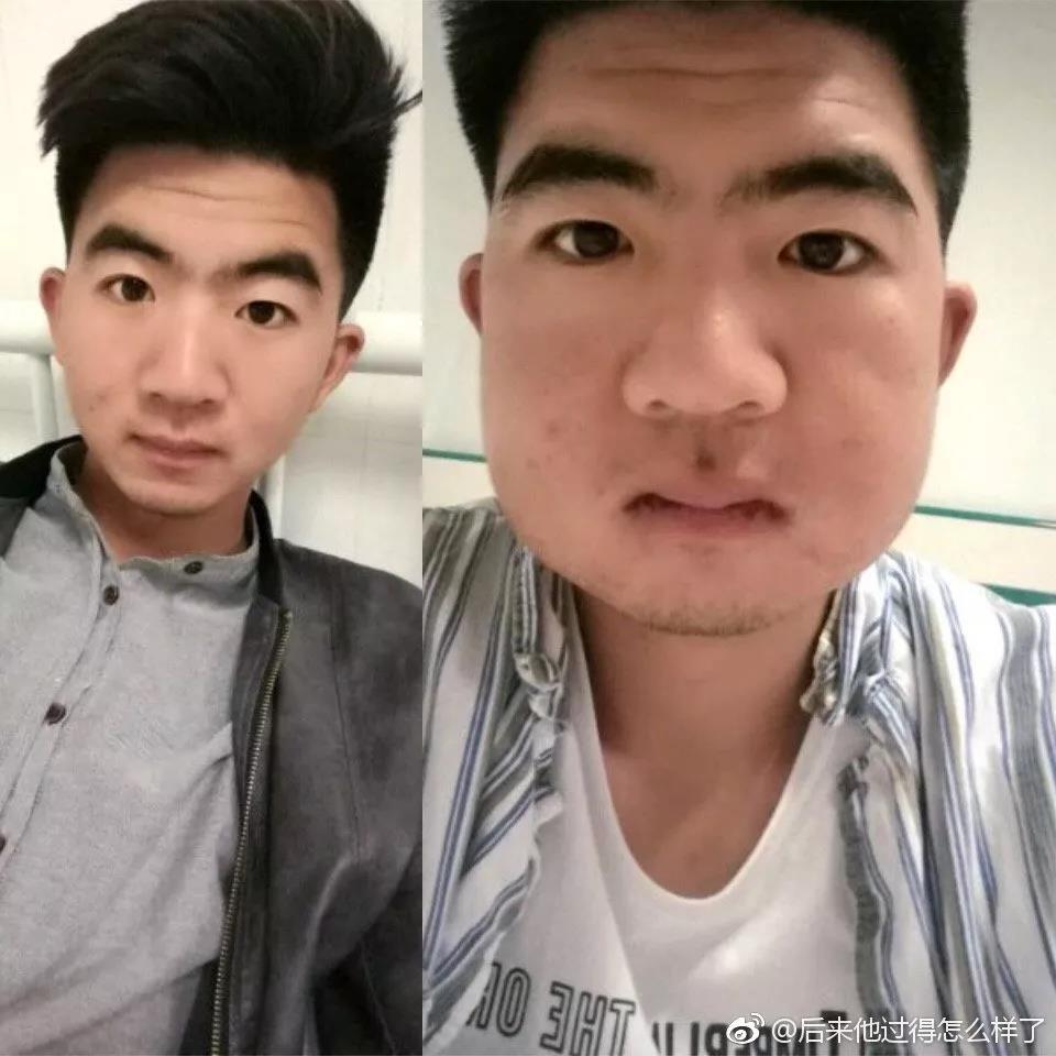 拔了一颗智齿花了1300元贵吗,拔个智齿花了800