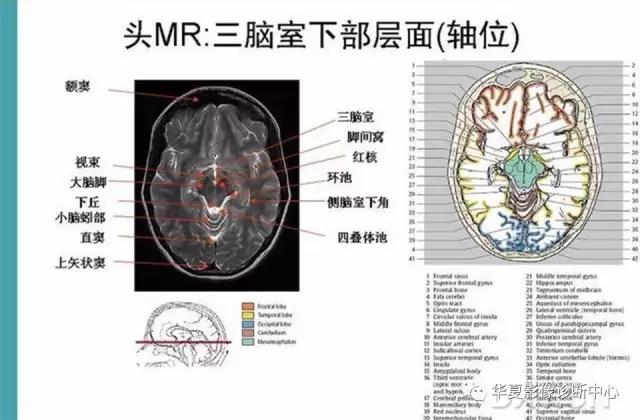 mra头颅解剖学详细讲解视频,常见的头颅mri图像