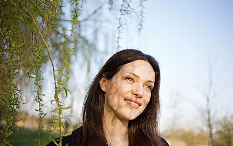 为什么有的人没有酒窝呢,为什么有的人只有一侧有酒窝