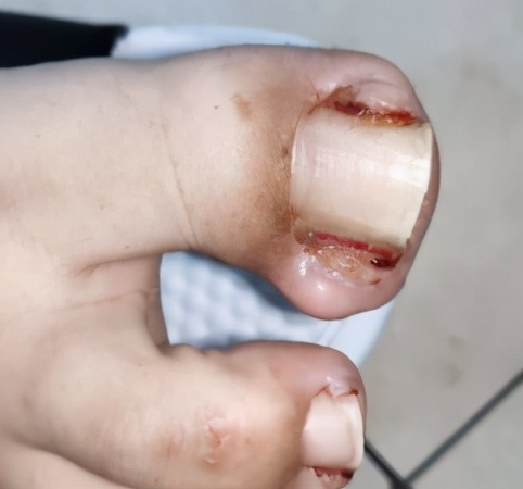 拔甲可以彻底治好嵌甲性甲沟炎吗,嵌甲甲沟炎拔了指甲还是红肿有脓