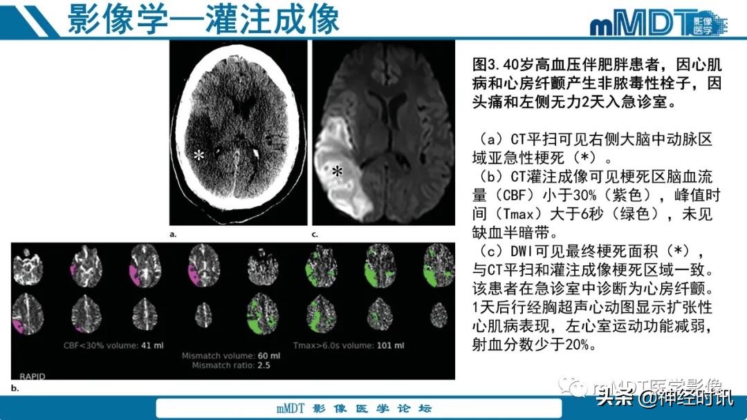 缺血性脑卒中护理课件,缺血性脑卒中讲课ppt