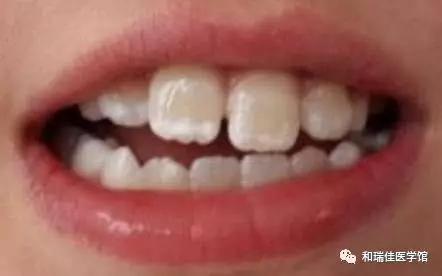 9岁孩子牙齿上有白斑是什么原因,孩子新换的牙齿有白斑是什么原因