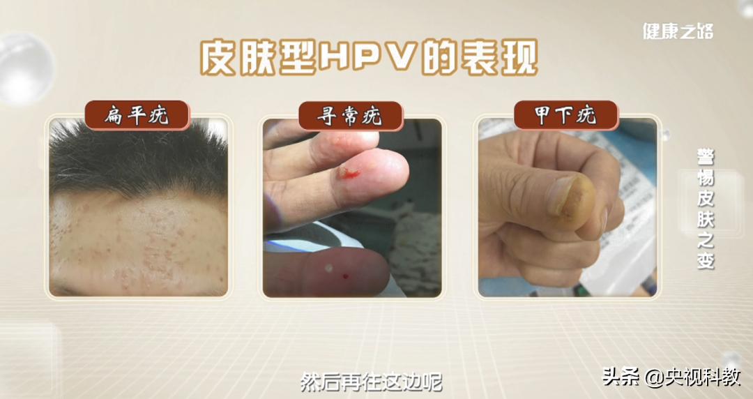 皮肤病毒疣的症状,皮肤疱疹病毒症状