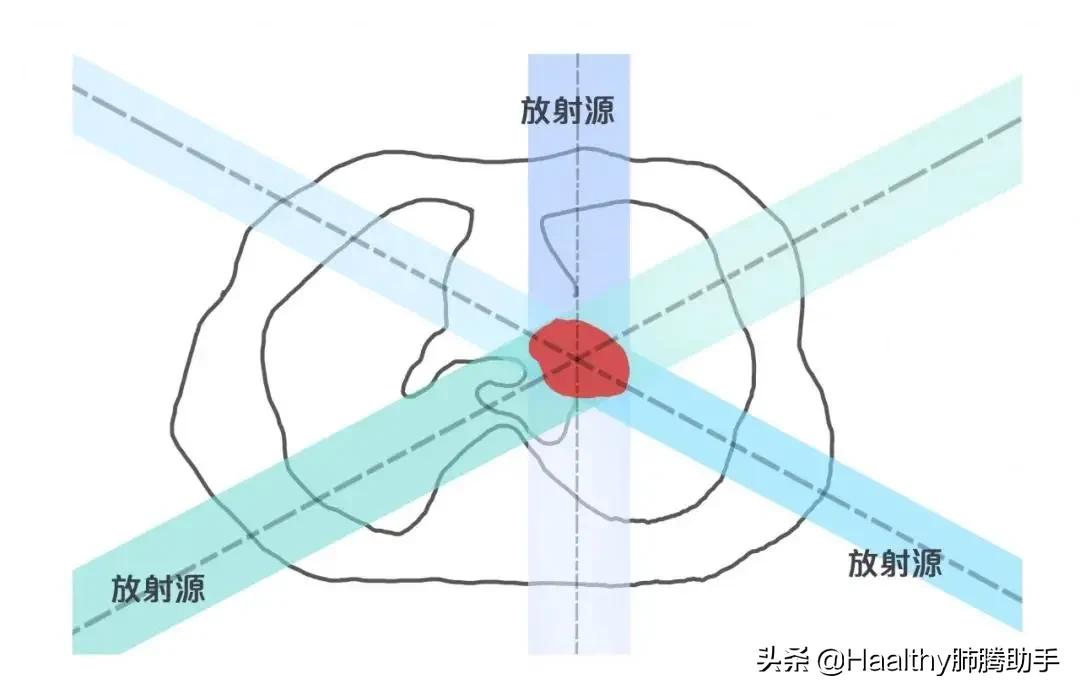 带着射线逛街,很拉风吧|肺腾讲堂:内放疗与外放疗的区别