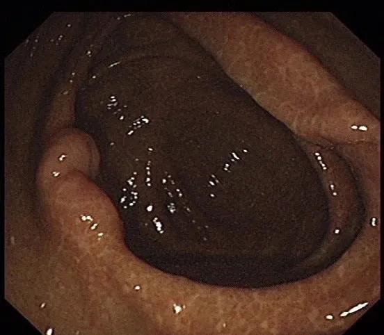 3d腹腔镜结肠手术,顽固性便秘的腹腔镜微创手术