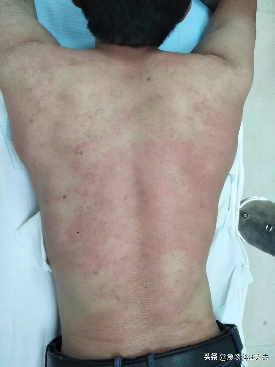 被蜜蜂蜇了是什么征兆需要就医,被两根刺的蜜蜂蛰了会怎么样