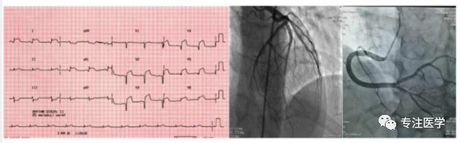 急性重症心肌炎护理查房,急性心肌炎