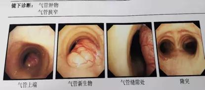 儿童90%为良性，成人却不到10%？患者气短3年，胸部CT提示的气管肿物意味着什么？气管镜有何发现？