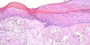 沈阳外阴白斑如何彻底根治,沈阳医大二院外阴白斑