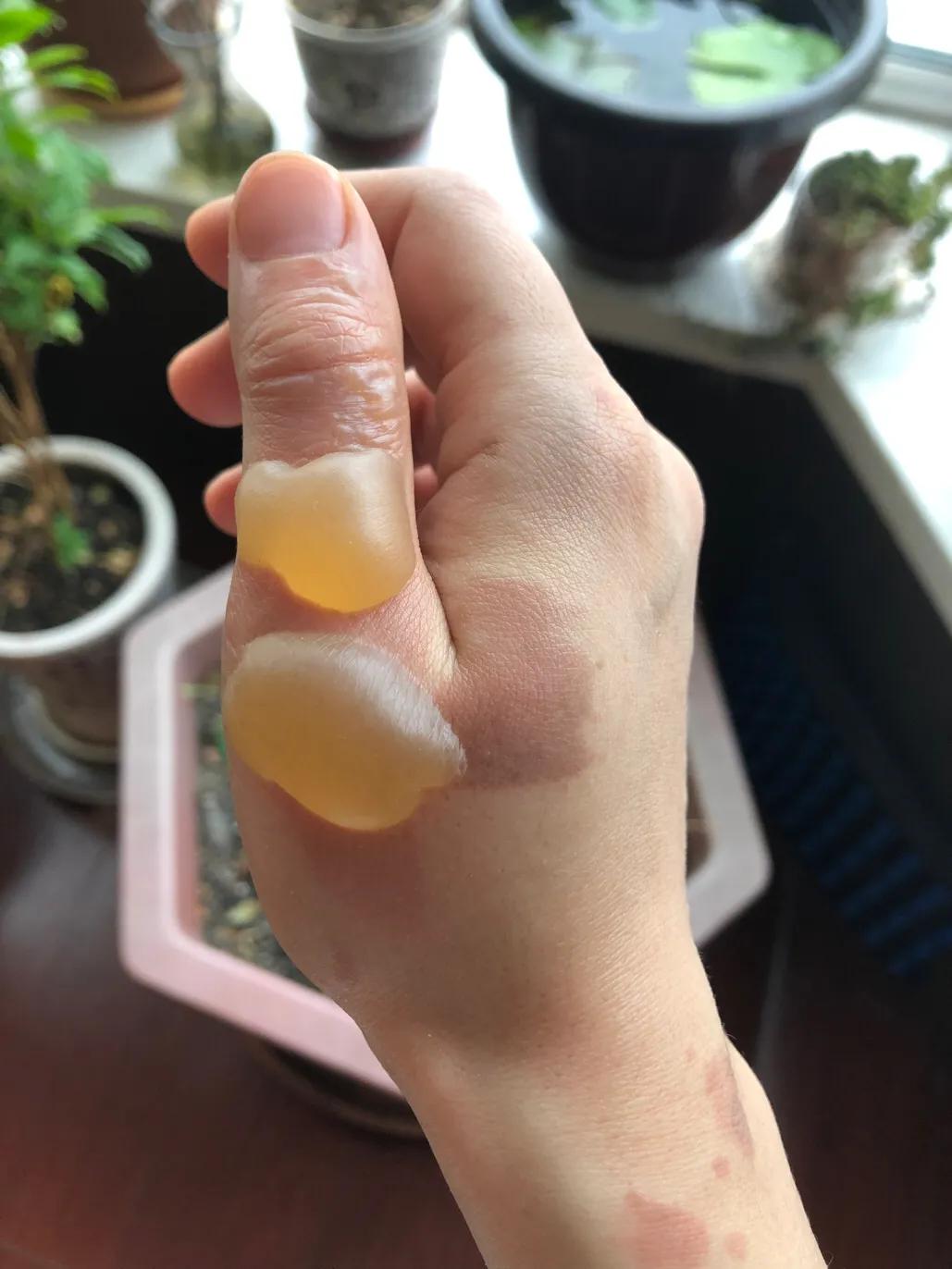 疫情期间低温烫伤的水泡怎么处理,烫伤后二十二天基本都平了