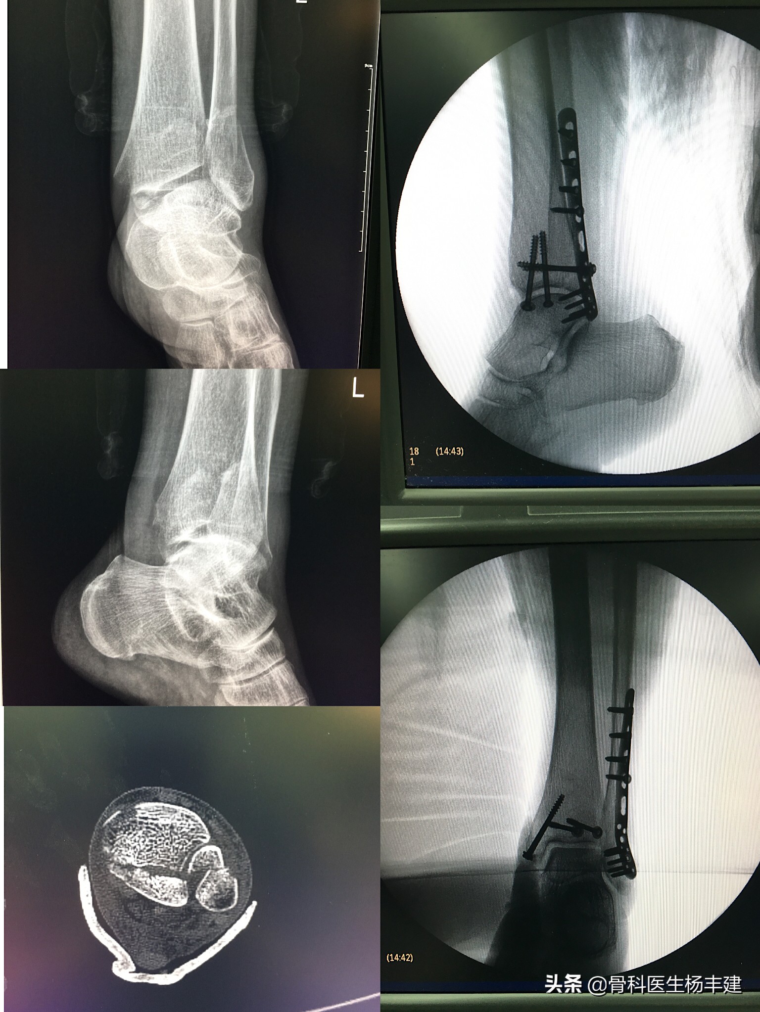 骨折保守治疗一定要手法复位吗,医生科普骨折的视频