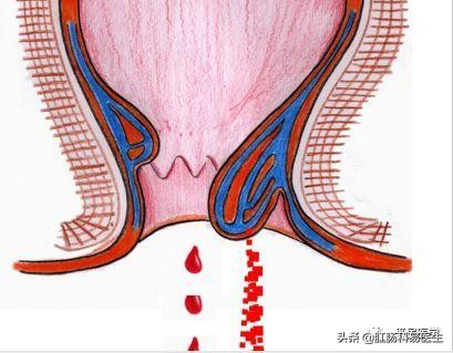 你了解过直肠炎吗？它的临床表现有哪些？