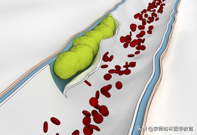 脑血栓形成的考试题,执业医师考试脑血管疾病视频