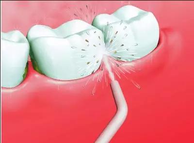 冲牙器能替代牙线,冲牙器到底能不能用