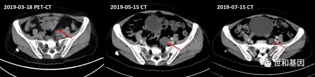 精益求精，抗血管和免疫药物的临床应用经典病例丨束永前教授