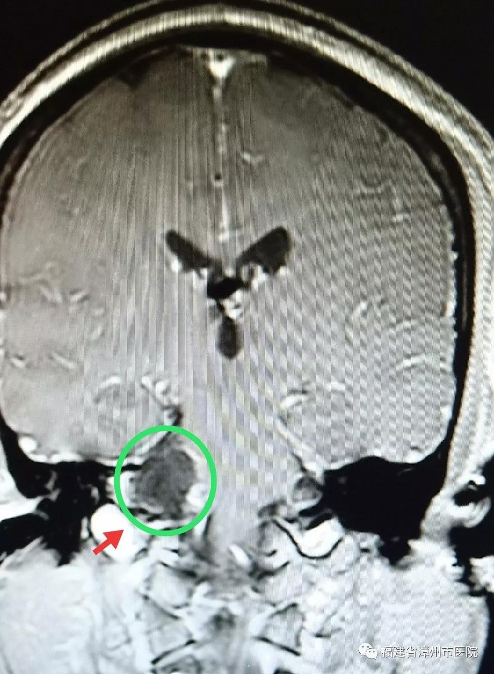 听力下降是耳朵出问题吗,着急一侧耳朵耳鸣听力减退