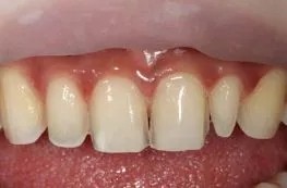 一白遮百丑斑点毁所有,一白遮千丑一穷毁所有