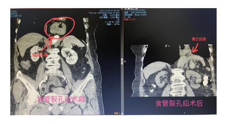 81岁老人胃癌晚期症状胃出血,老人胃吐血可能是什么病