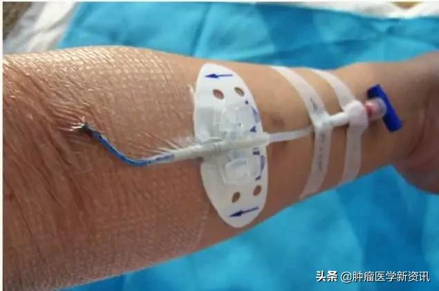 21年里患癌5次他被医生赞为传奇,三度患癌却依然成功抗癌30年