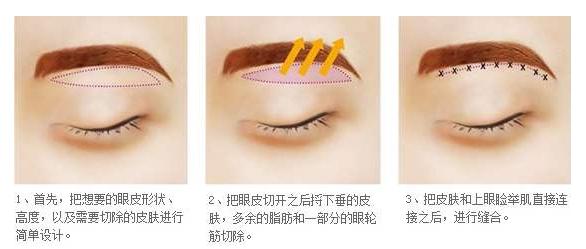 眼皮松弛下垂最好解决方法,眼皮松弛下垂最好解决方法小妙招