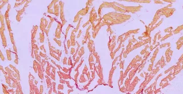 腘绳肌二级拉伤和三级拉伤的区别,大腿内侧拉伤韧带