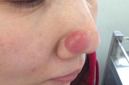 脸上长痘是身体原因还是皮肤原因,脸上长痘可能是什么病引起的