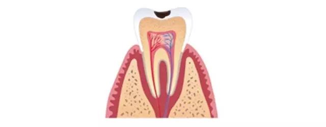 补牙补到牙齿都秃没了,补牙快到牙神经了补完咬合疼