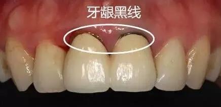 几千块补牙不如几百块?医术还是牙齿问题?这么做,注定钱打水漂