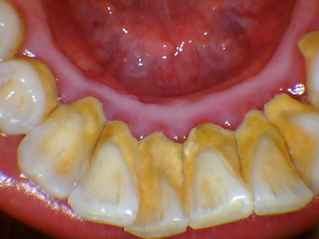 牙缝很臭?口腔有异味?你刷牙方式对过吗?