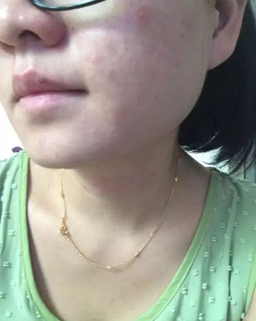 化妆品过敏会不会引起全身过敏,化妆品过敏是什么原因导致的