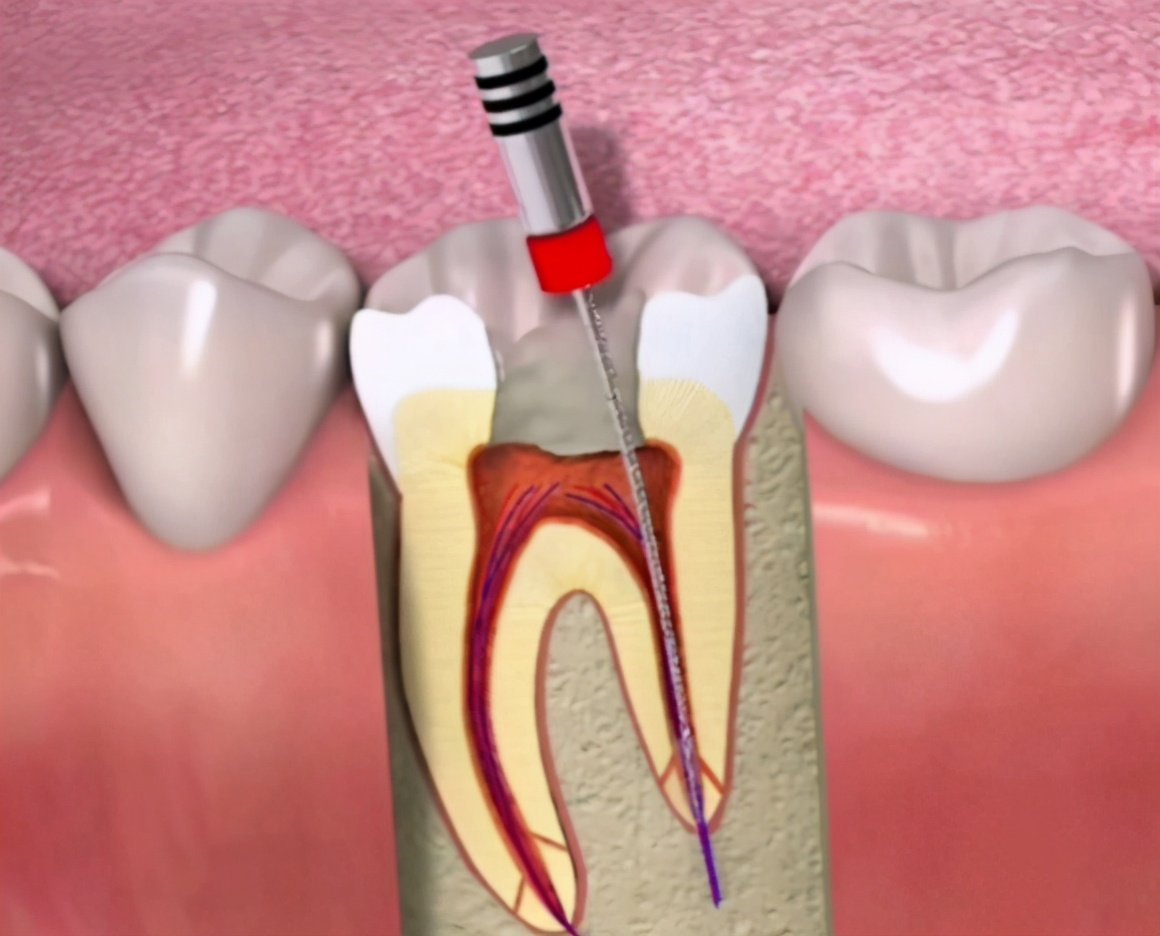 急性牙髓炎诊断错牙齿了怎么办,门牙牙髓坏死根尖炎怎么办