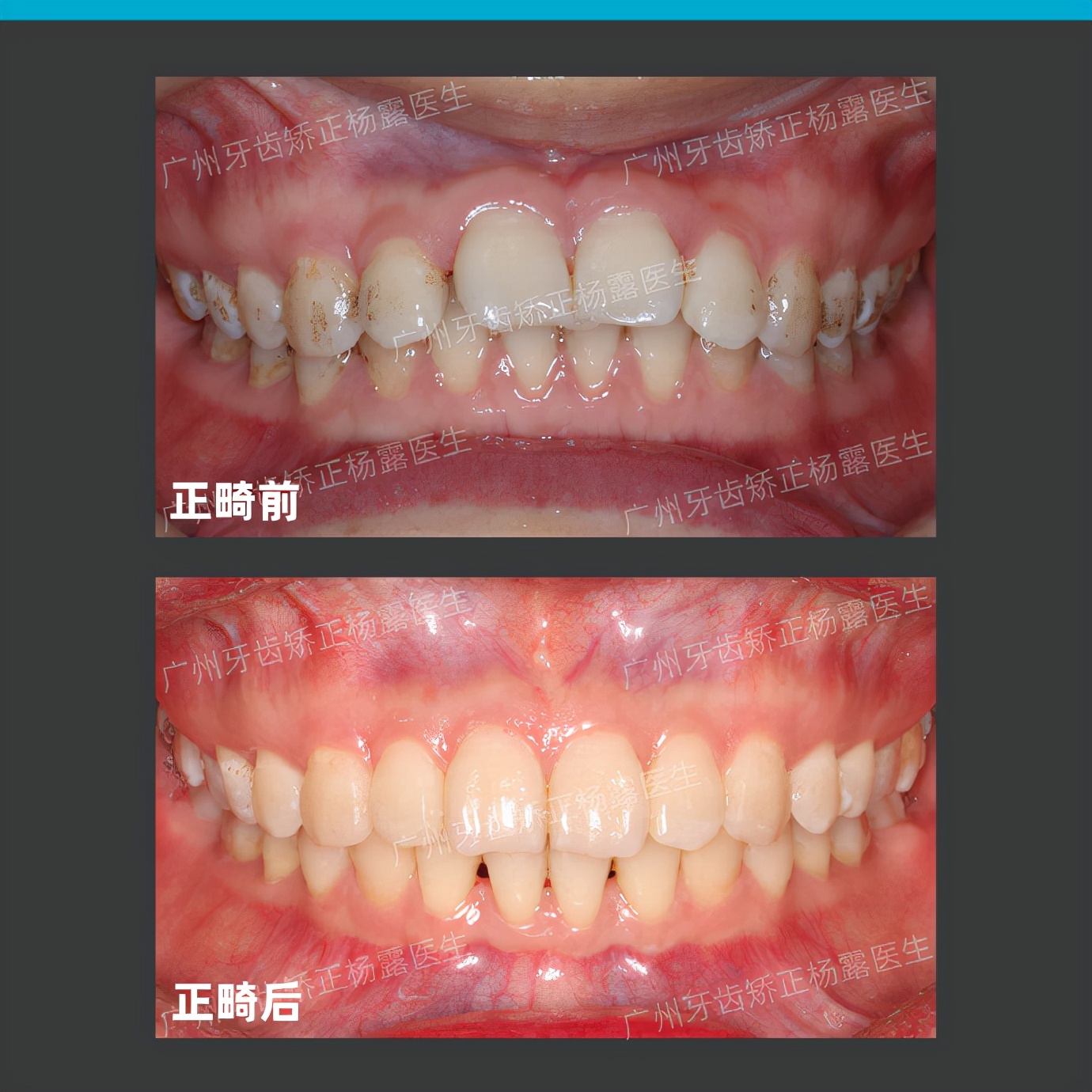 广州牙齿矫正整牙视频,牙齿深覆盖加龅牙怎么矫正
