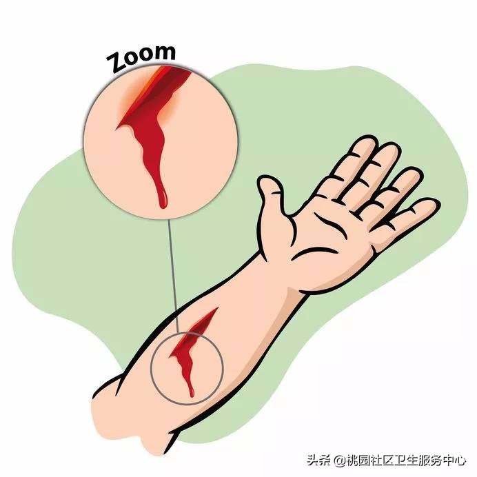 一厘米长的伤口要打破伤风吗,小孩碰个小伤口打破伤风吗