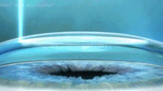 近视眼手术后的亲身经历2020,近视眼手术10年后的亲身经历