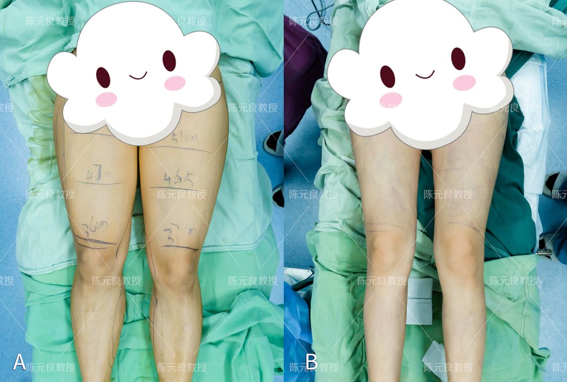 想吸脂减肥具体需要怎么做,想做个吸脂去哪家医院