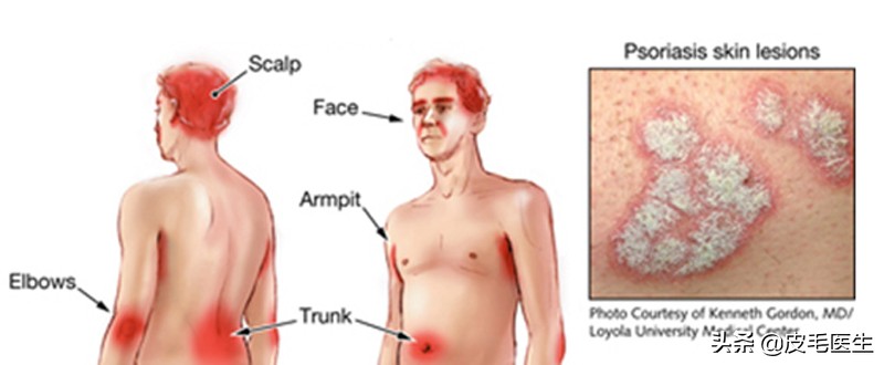 浑身瘙痒有很多皮屑,浑身瘙痒起鸡皮疙瘩怎么回事