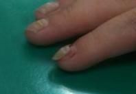 发现手足口病要及时就医吗,注意这7点咽炎远离你