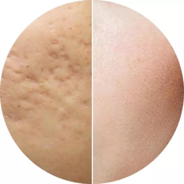 库博士祛痘痘效果怎么样,库博士专业祛痘长沙