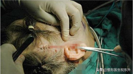 拉皮手术难度有多高,大拉皮手术做完前后对比图