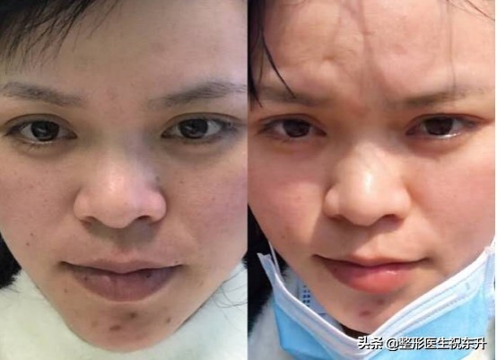 打水光针要知道的问题,说打水光针害怕针眼怎么回答