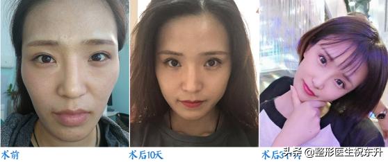 自体脂肪丰苹果肌的效果如何,填充苹果肌用自体脂肪还是玻尿酸