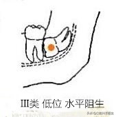 智齿分轻重嘛,智齿水平和非水平的区别