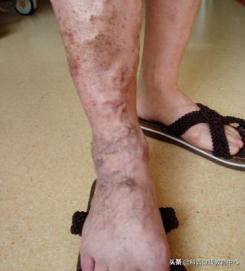 静脉曲张患者预防血栓形成锻炼操,怎样防止静脉曲张血栓