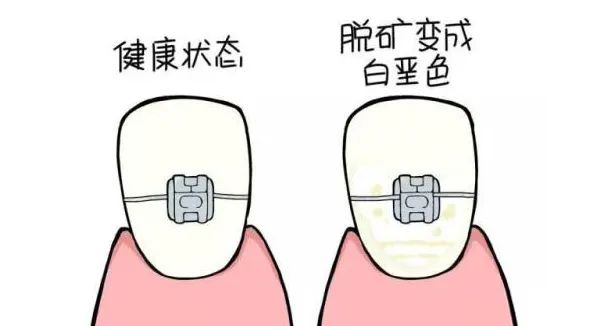 牙齿发脆容易碎,吃柠檬牙齿脱矿