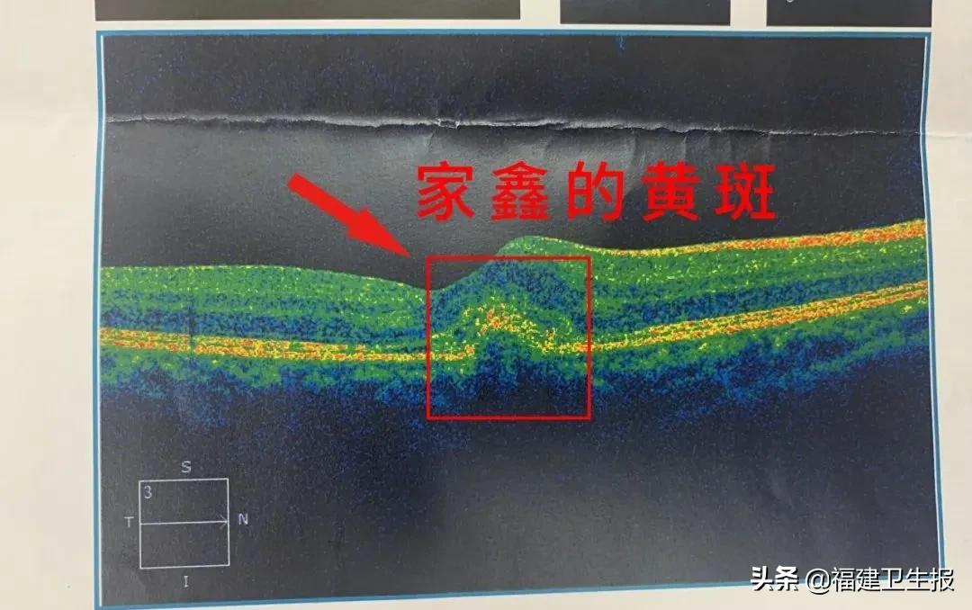 7宀佺敺瀛╁彸鐪艰鐑т激,7宀佺敺瀛╃溂鐫涜鐑т激