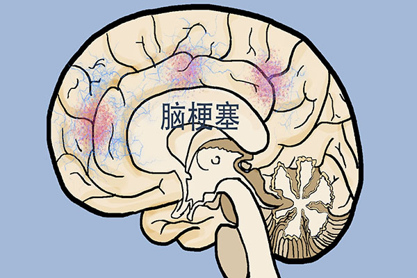 轻度脑梗前期的征兆是什么样的,得了脑梗轻度的要注意哪些方面