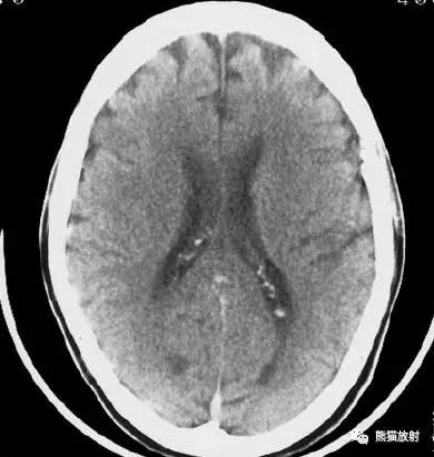 脑梗死丨演变、血供区域分布、CT表现