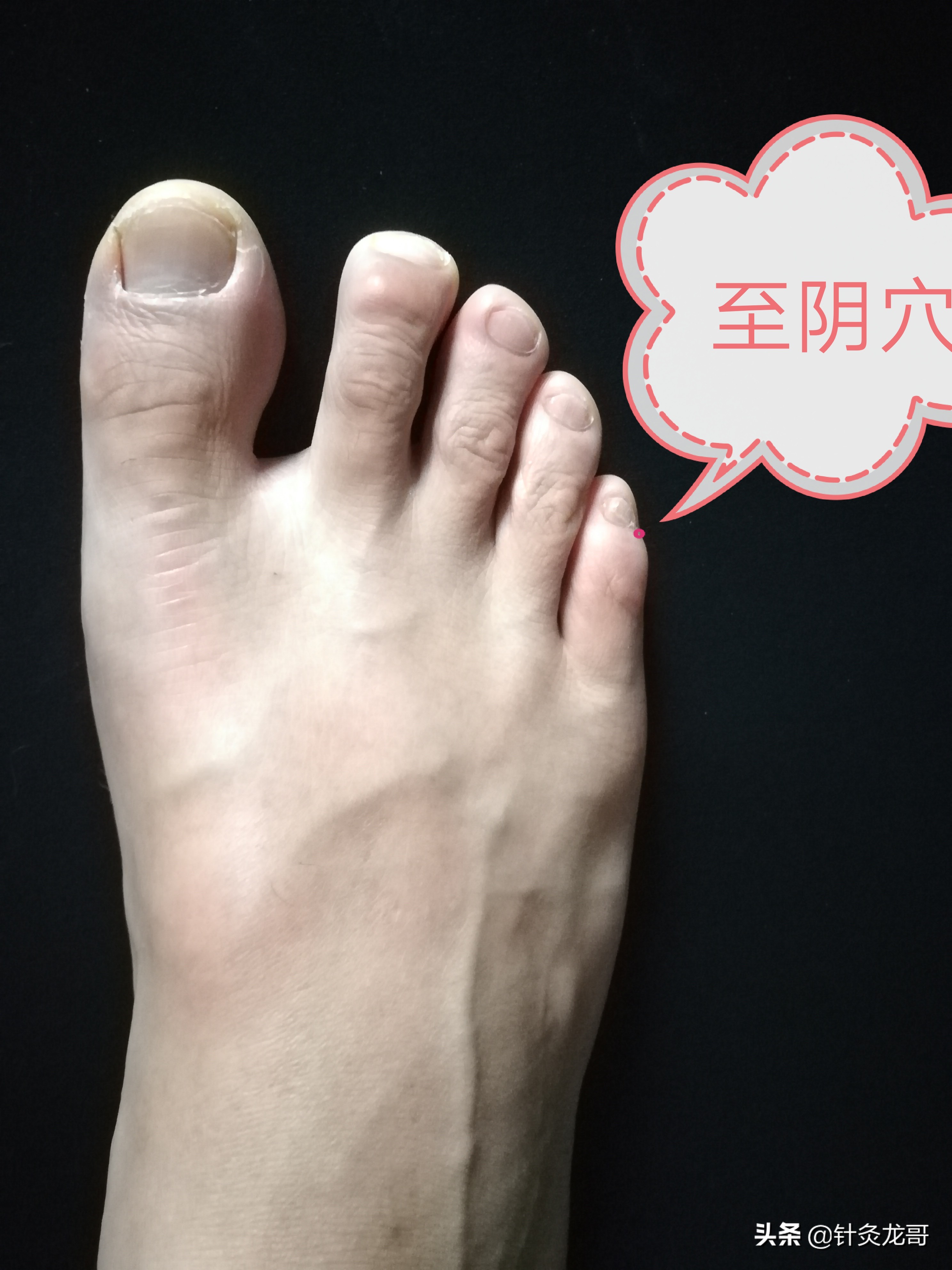 为什么扎针越来越扎不好,为什么扎针扎不进去呢