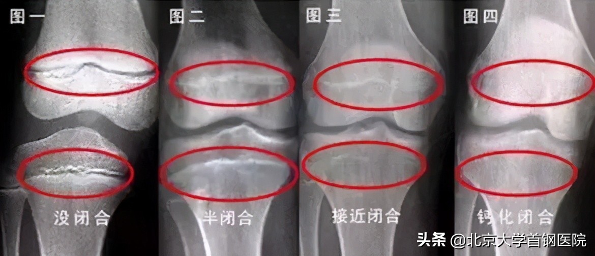 儿童身材矮小看什么科室,女孩身高矮小要看什么科